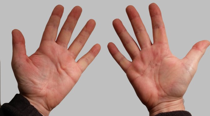 Experience of People Living with Dupuytren’s Contracture